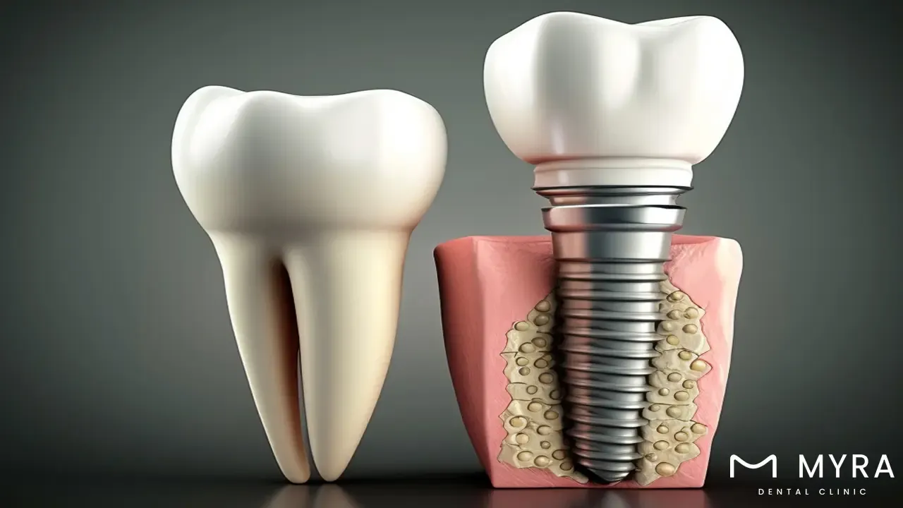 whats a dental implant.webp